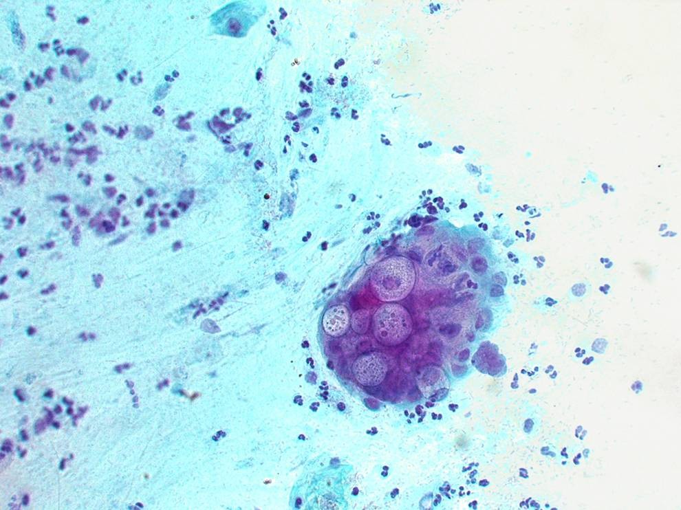 Chlamydia trachomatis